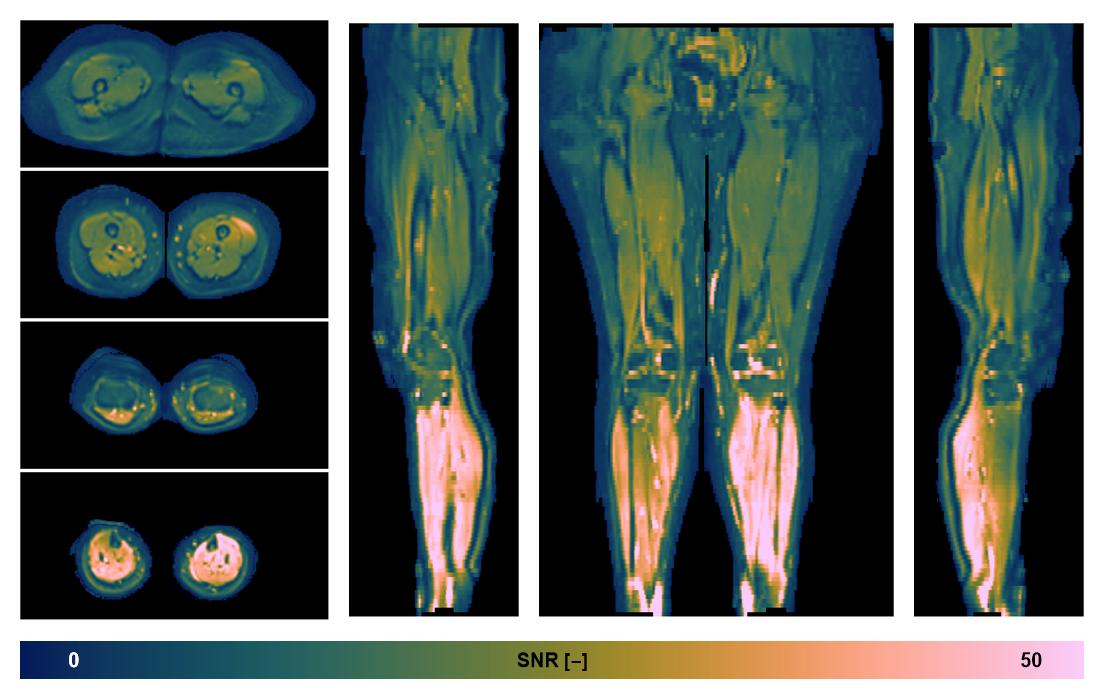 SNR distribution of the unweighted diffusion data.